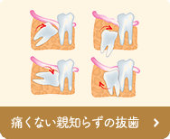 痛くない親知らずの抜歯