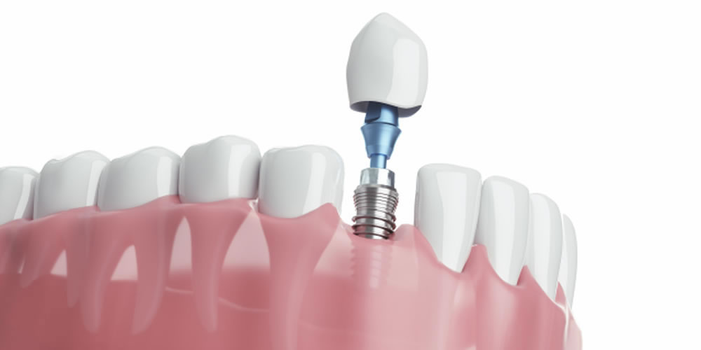 インプラント治療の相場と見積りの見極め方