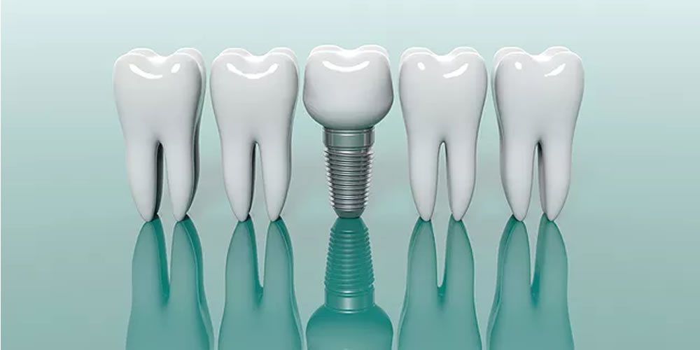 インプラント治療の費用に価格差が生まれる理由