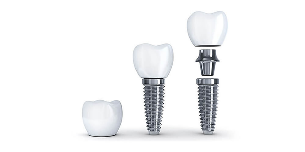 インプラント体のメーカーとグレード