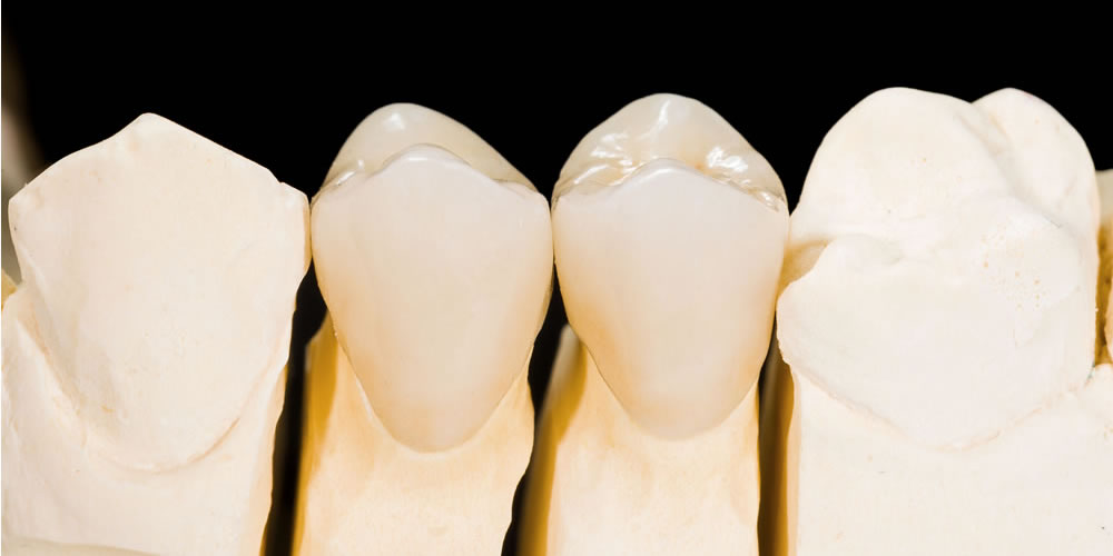 人工歯（かぶせ物）の素材