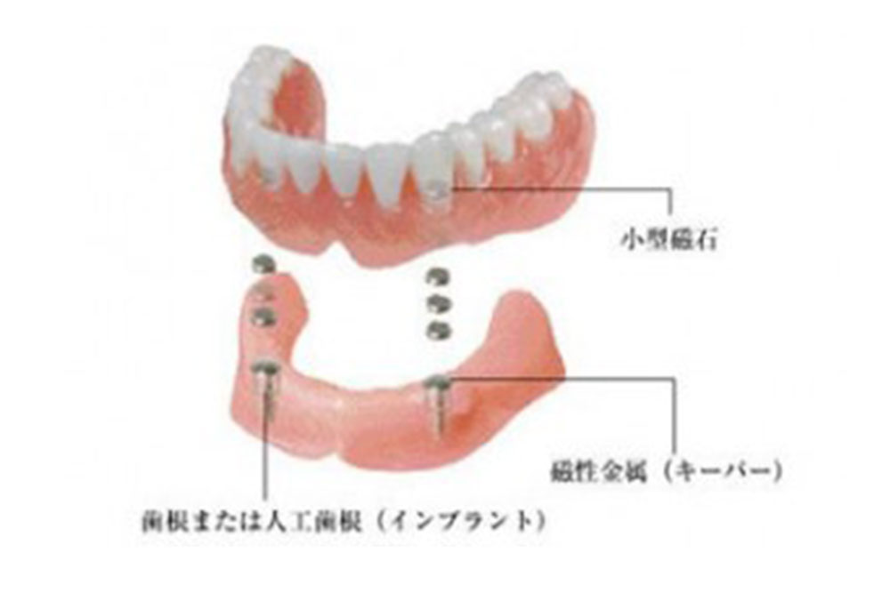 強く噛める磁性マグネットデンチャー