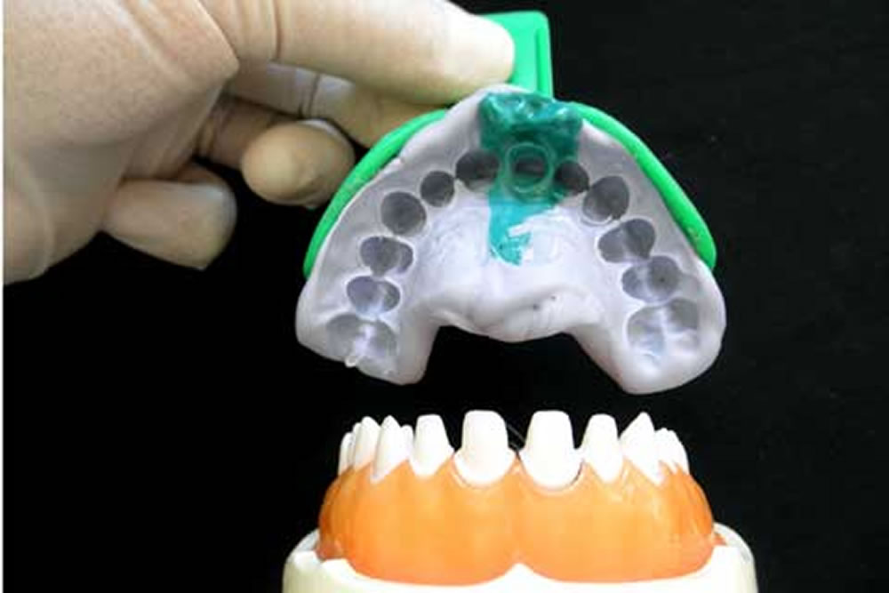 シリコン印象剤を使った型取り