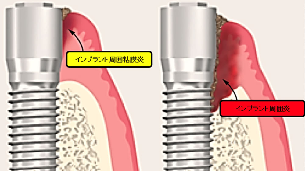 インプラント粘膜炎と周囲炎の違い