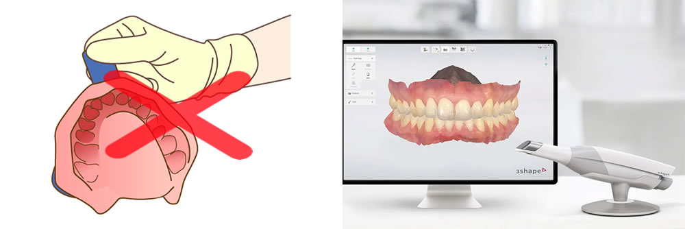 3D光学スキャナー「トリオス」による快適な歯型の採取