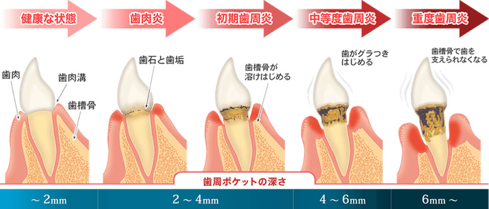 歯周病の進行状態