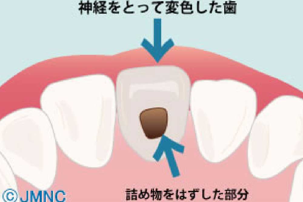 インターナルブリーチ